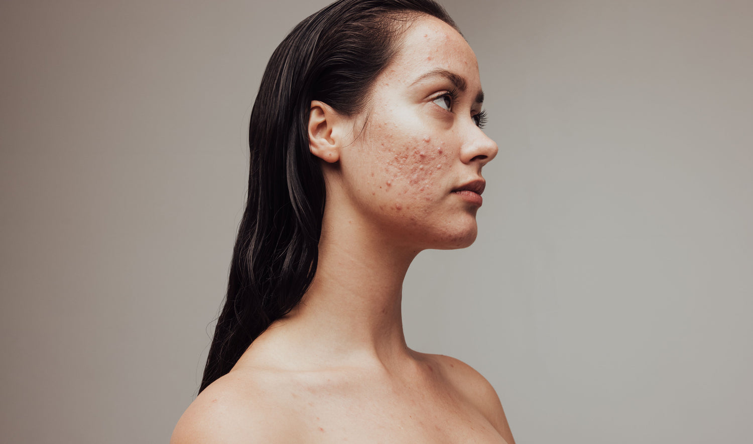 Major Differences Between Pimples And Acne